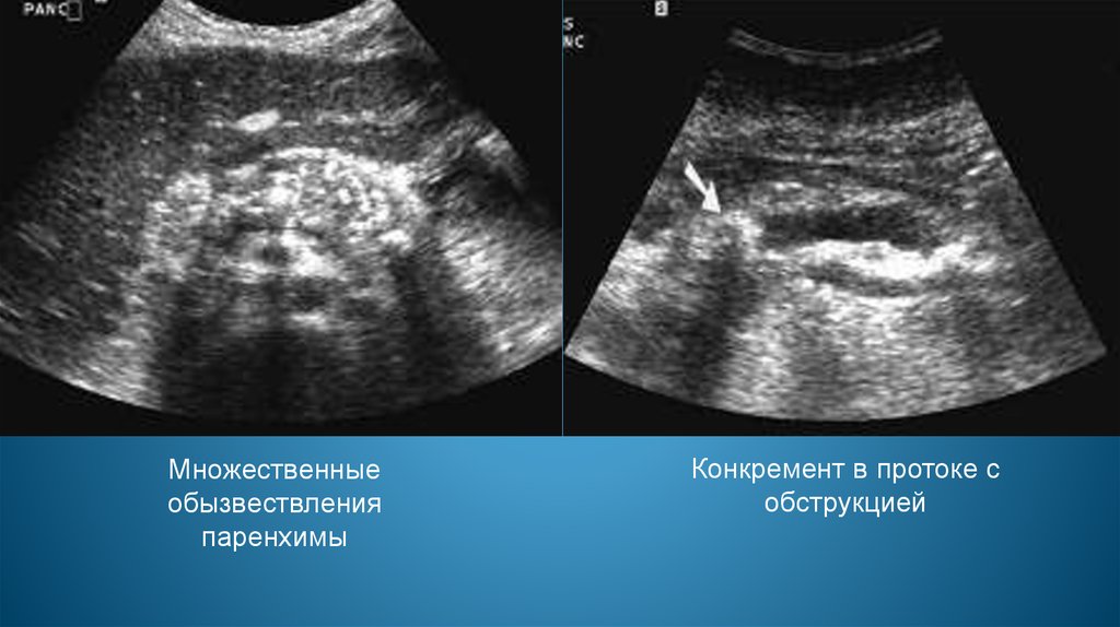 Размеры поджелудочной на узи. УЗИ поджелудочной железы презентация. Конкремент паренхимы печени на УЗИ. УЗИ поджелудочной Шуя. CF[fhysq LBF,TN E ltntq диагностика УЗИ поджелудоной.