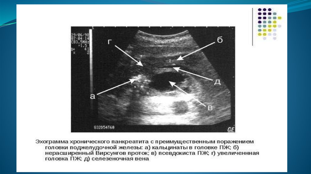 Объемное образование поджелудочной железы