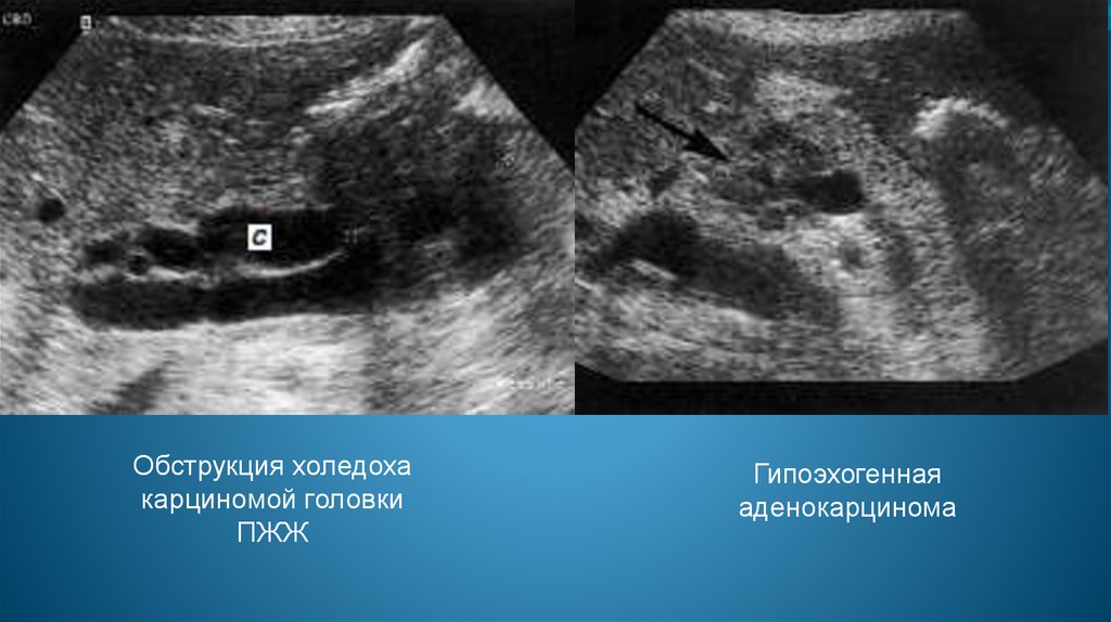 На узи видно поджелудочную железу. Кольцевидная поджелудочная железа УЗИ. Доброкачественные образования поджелудочной железы УЗИ. Цистаденома поджелудочной железы на УЗИ. Липоматоз поджелудочной железы на УЗИ.