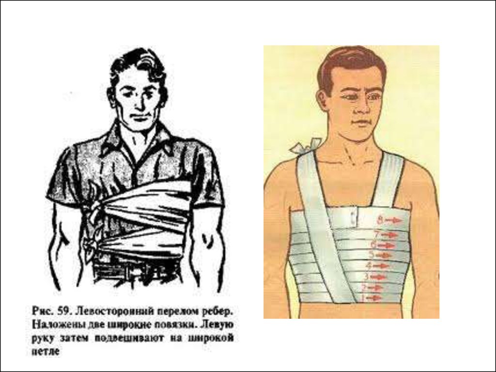 Первая медицинская помощь при переломе ребер. Иммобилизация при переломе ребер и грудины. Иммобилизация при переломе ребер. Транспортная иммобилизация при переломе ребер. Транспортная иммобилизация при переломах ребер и грудины.