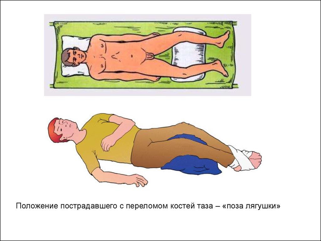 Положение 60. Положение лягушки при переломе таза. Положение Волковича при переломах таза. Поза лягушки при переломе костей таза. Положение лягушки при переломе костей таза.