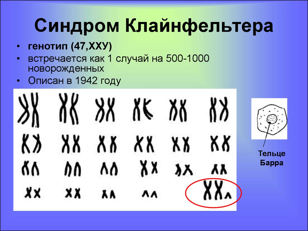 Появление дополнительной хромосомы. Синдром Клайнфельтера кариотип. Синдром Клайнфельтера кариограмма. Формула кариотипа при синдроме Клайнфельтера.