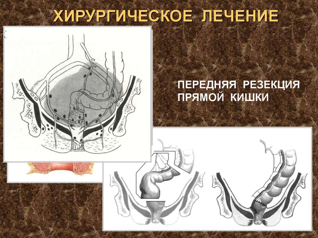 Лечение прямой кишки. Низкая передняя резекция прямой кишки ход операции. Чрезбрюшная резекция прямой кишки. Передняя резекция прямой кишки выполняется. Внутрибрюшная передняя резекция прямой кишки.