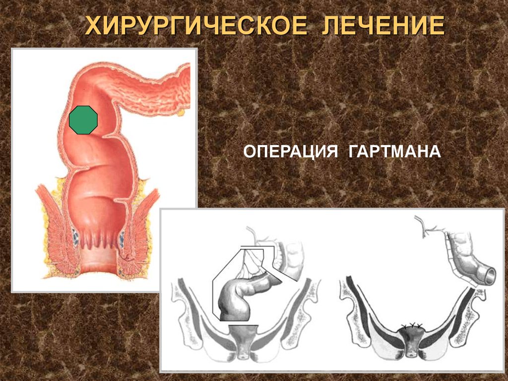 Презентация операции на прямой кишке