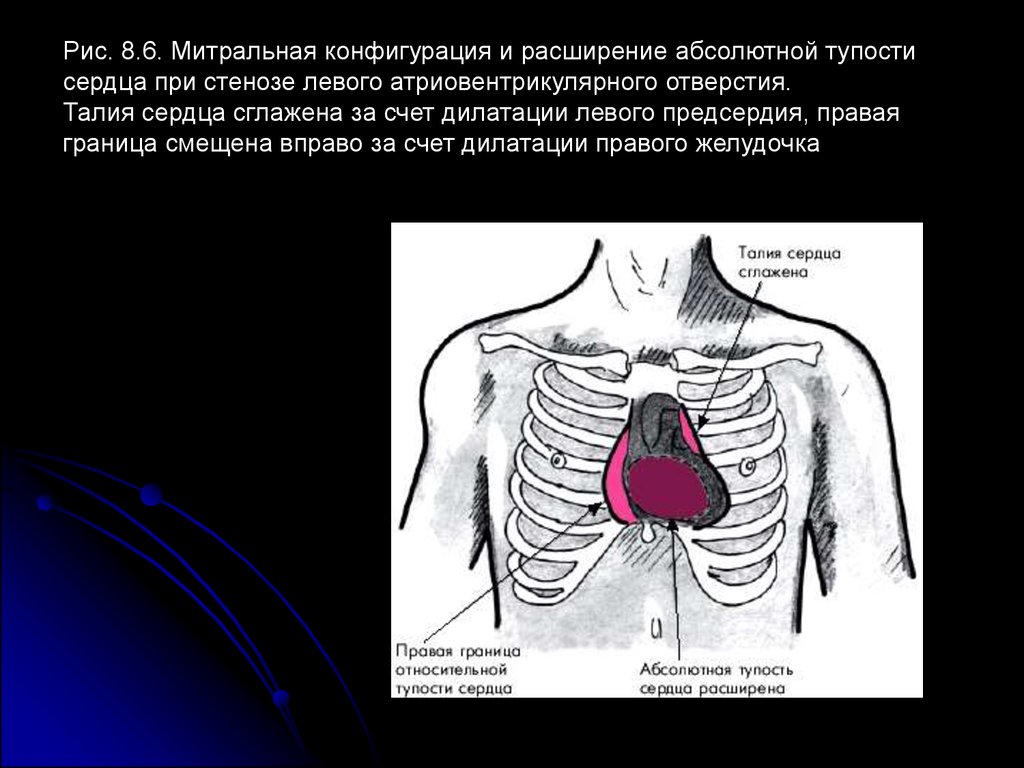 Границы расширены влево. Абсолютная сердечная тупость при гипертрофии левого желудочка. Абсолютная тупость сердца при гипертрофии правого желудочка. Конфигурация относительной тупости сердца. Митральная конфигурация сердца при перкуссии.