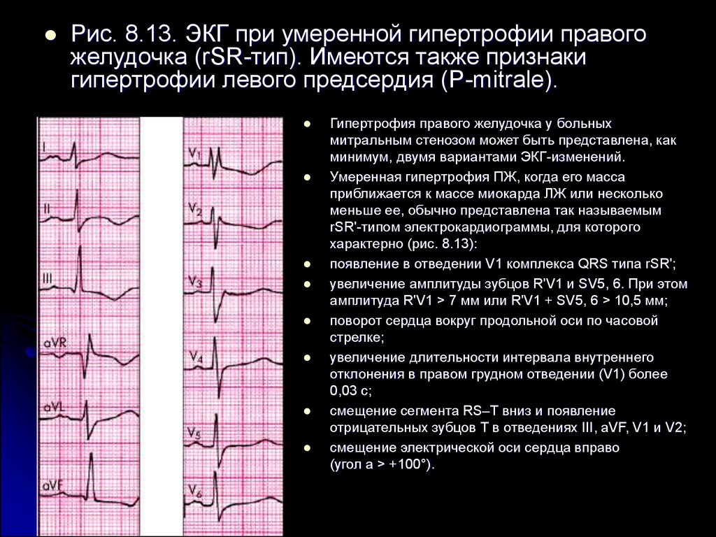 Изменения миокарда предсердий. ЭКГ при гипертрофии предсердий и желудочков сердца. Изменения на ЭКГ при гипертрофии левого желудочка. ЭКГ при гипертрофии левого желудочка. ЭКГ синдром гипертрофии желудочков.