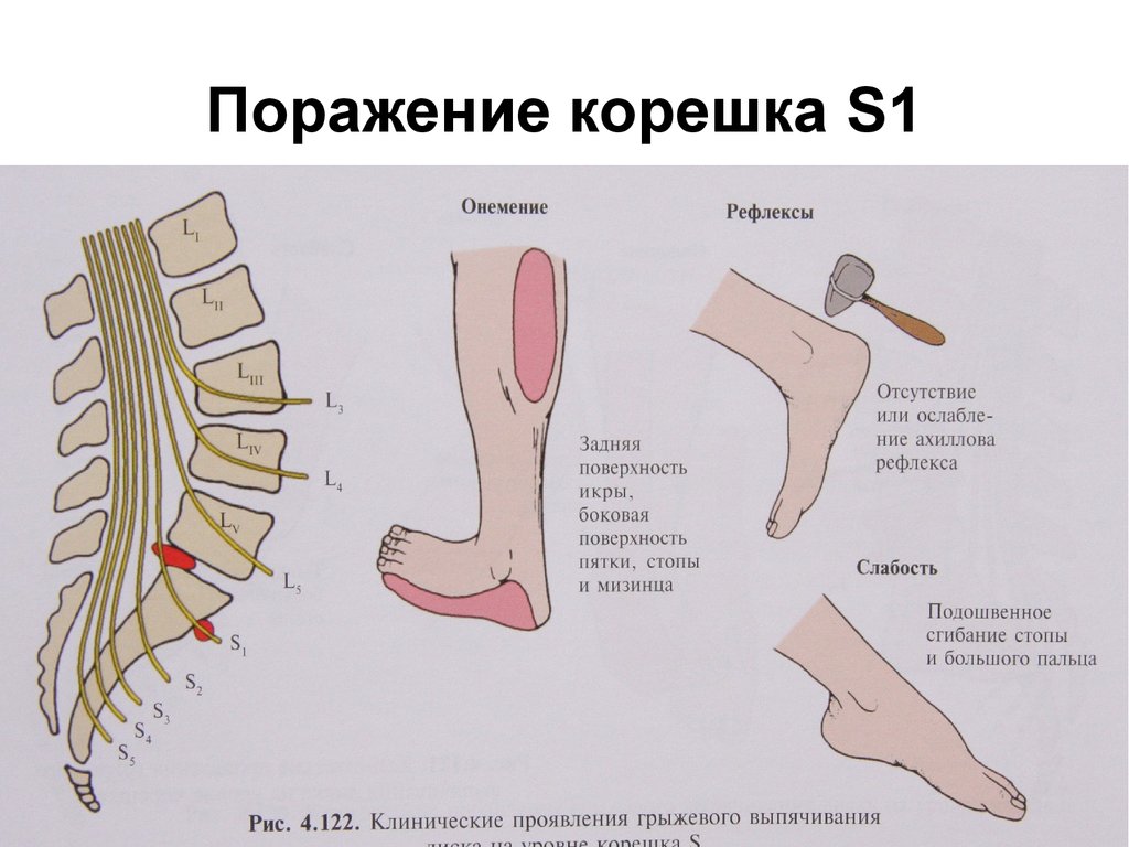 Грыжа позвоночника немеет рука. Корешки l4 l5. Компрессии корешка l5 или s1. Корешок l5-s1. Синдром компрессии корешка s1.