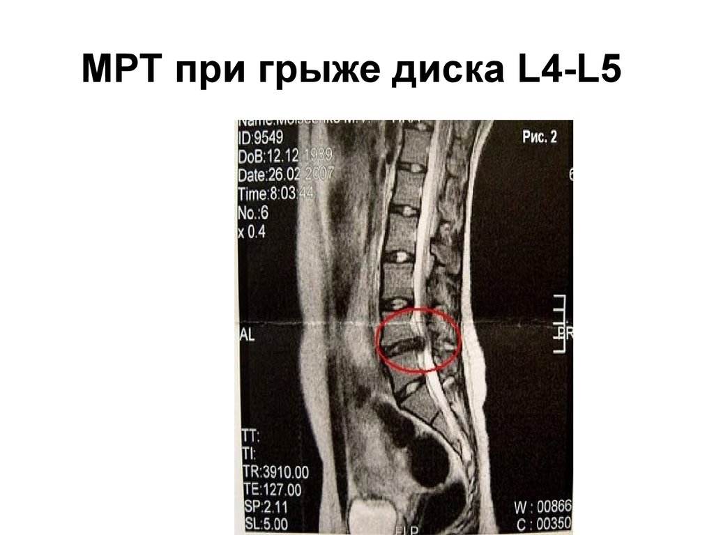 Протрузия дисков l2 l3 l4 l5