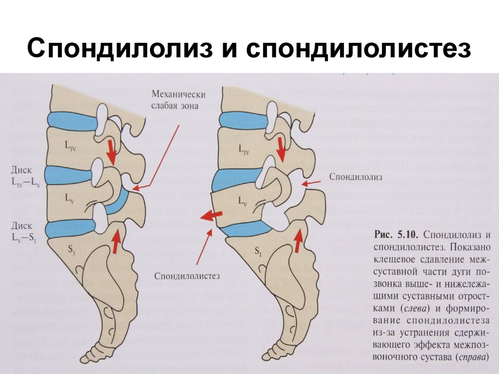 Спондилолистез. Спондилолиз l5 позвонка. Спондилолистез позвоночника l5. Дефект дужки l5 позвонка. Спондилолистез l5 рентген.