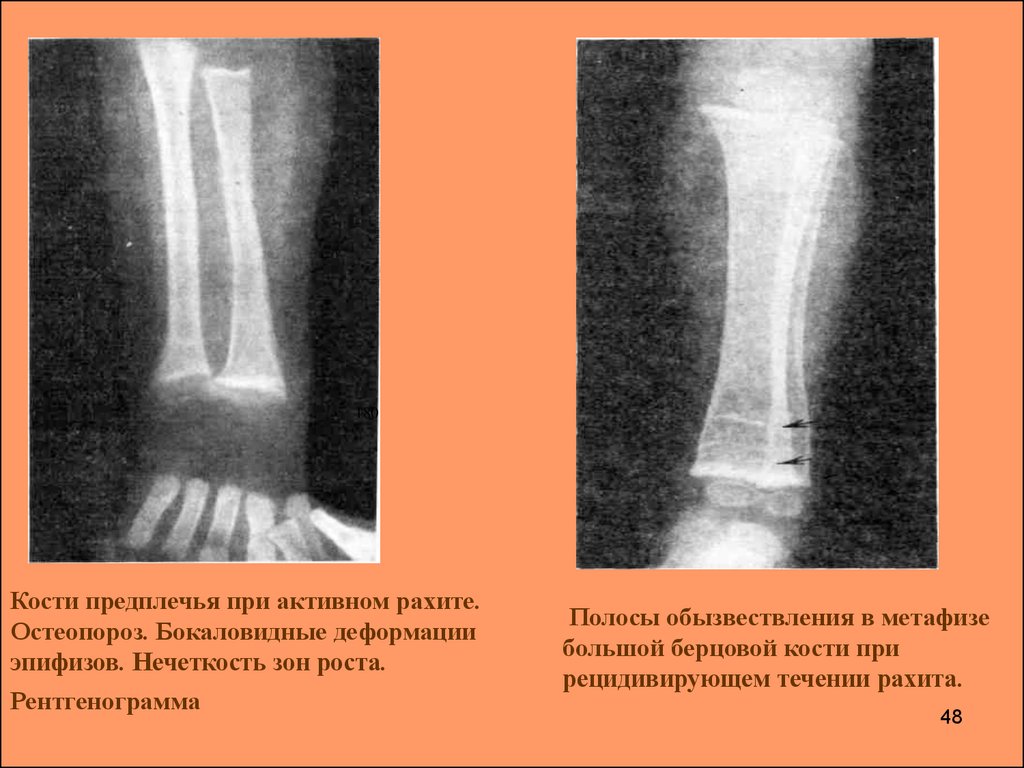 Деформация костей. Рентген костей при рахите. Рахит кости рентгенография. Хрупкость костей при рахите. Рентгенография трубчатых костей при рахите.