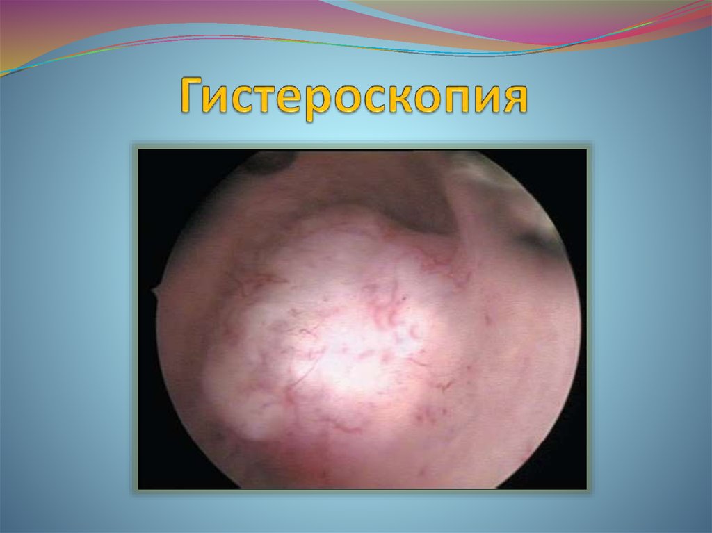 Гистероскопия