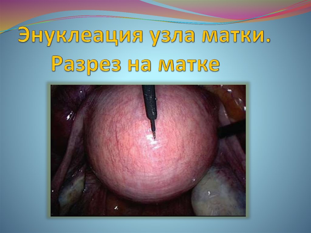 Энуклеация узла матки. Разрез на матке