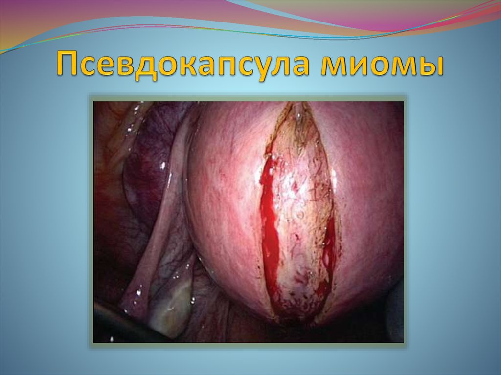 Псевдокапсула миомы