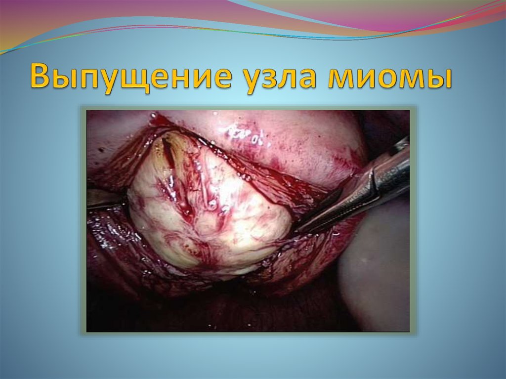 Выпущение узла миомы