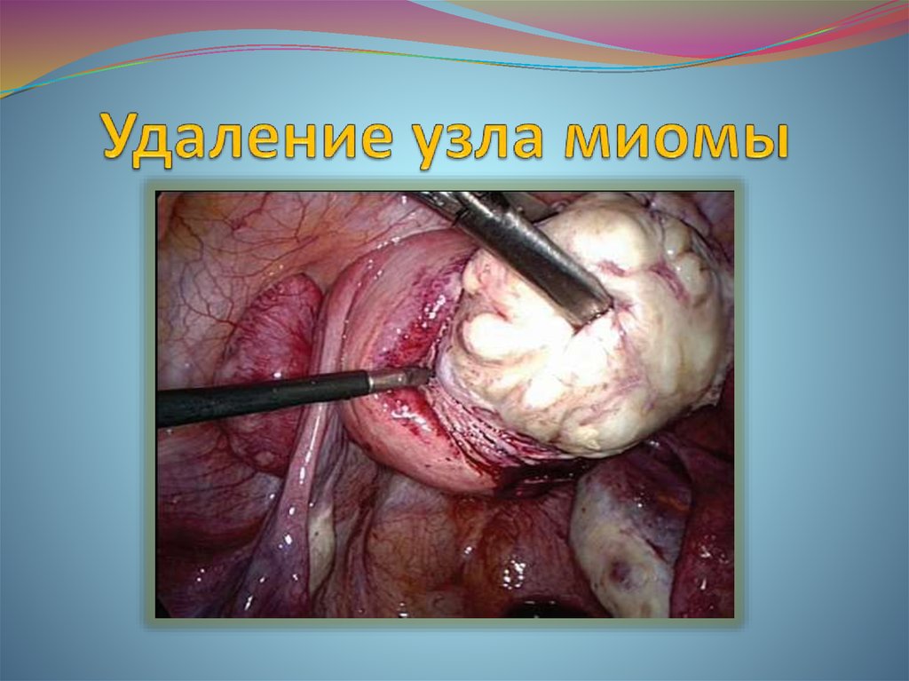 Удаление узла миомы