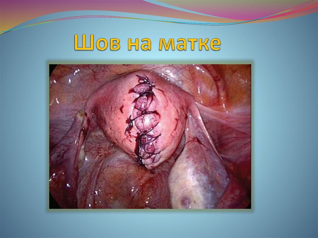 Шов на матке