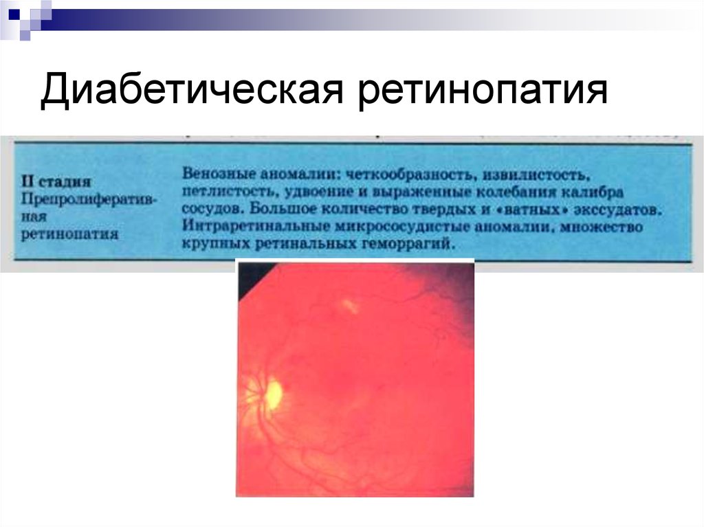 Диабетическая ретинопатия лечение. Диф диагноз диабетической ретинопатии. Диабетическая ретинопатия дифференциальный диагноз. Диабетическая ретинопатия механизм развития. Диабетическая ретинопатия этиология патогенез.