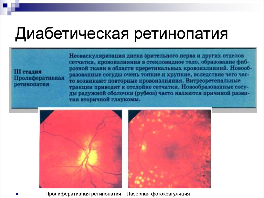 Диабетическая ретинопатия презентация офтальмология