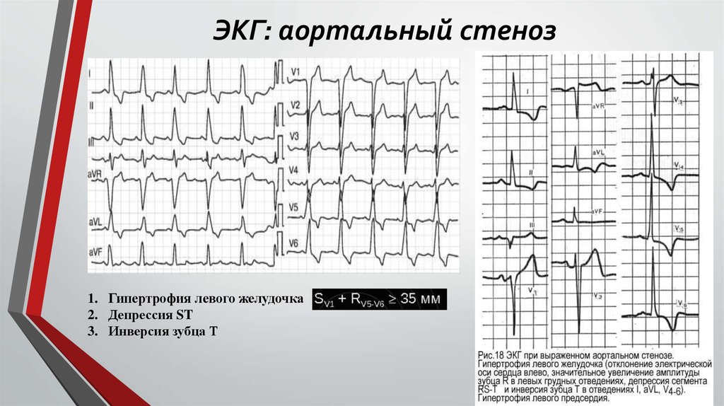 Экг при пролапсе митрального клапана фото