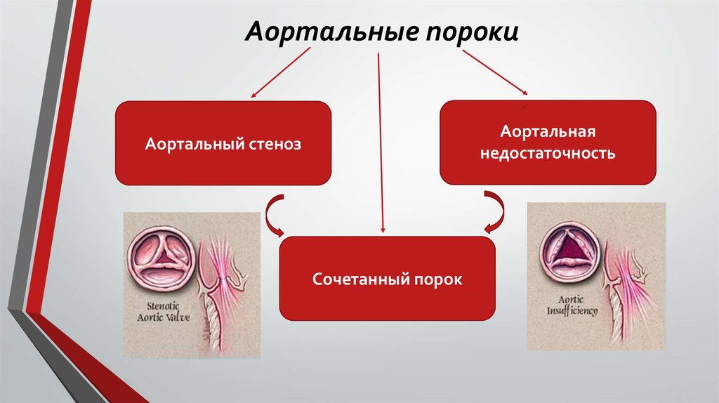 Аортальные пороки презентация