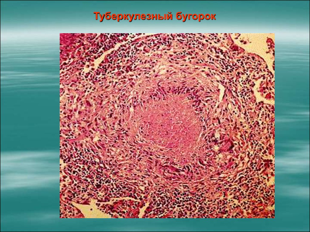 Туберкулезная гранулема рисунок