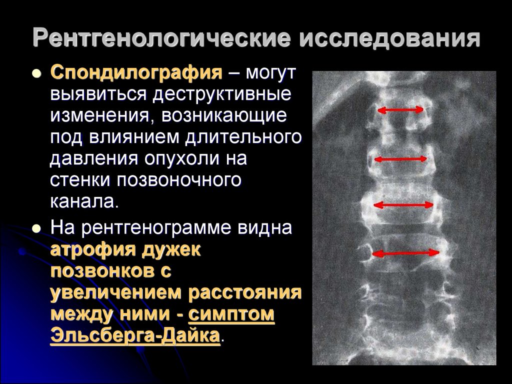 Изменение грудного отдела позвоночника. Опухоль спинного мозга на рентгене позвоночника. Рентгенологические симптомы остеохондроза позвоночника. Функциональное рентгенологическое исследование поясничного отдела. Функциональная спондилография шейного отдела позвоночника.