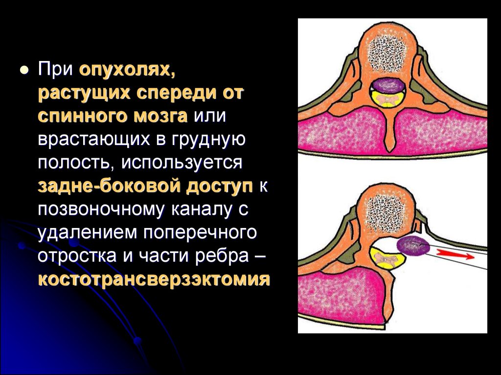 Опухоль спинного мозга. Экстрамедуллярные опухоли спинного мозга клиника. Опухоли головного и спинного мозга. Опухоли оболочек спинного мозга. Классификация опухолей позвоночника и спинного мозга.