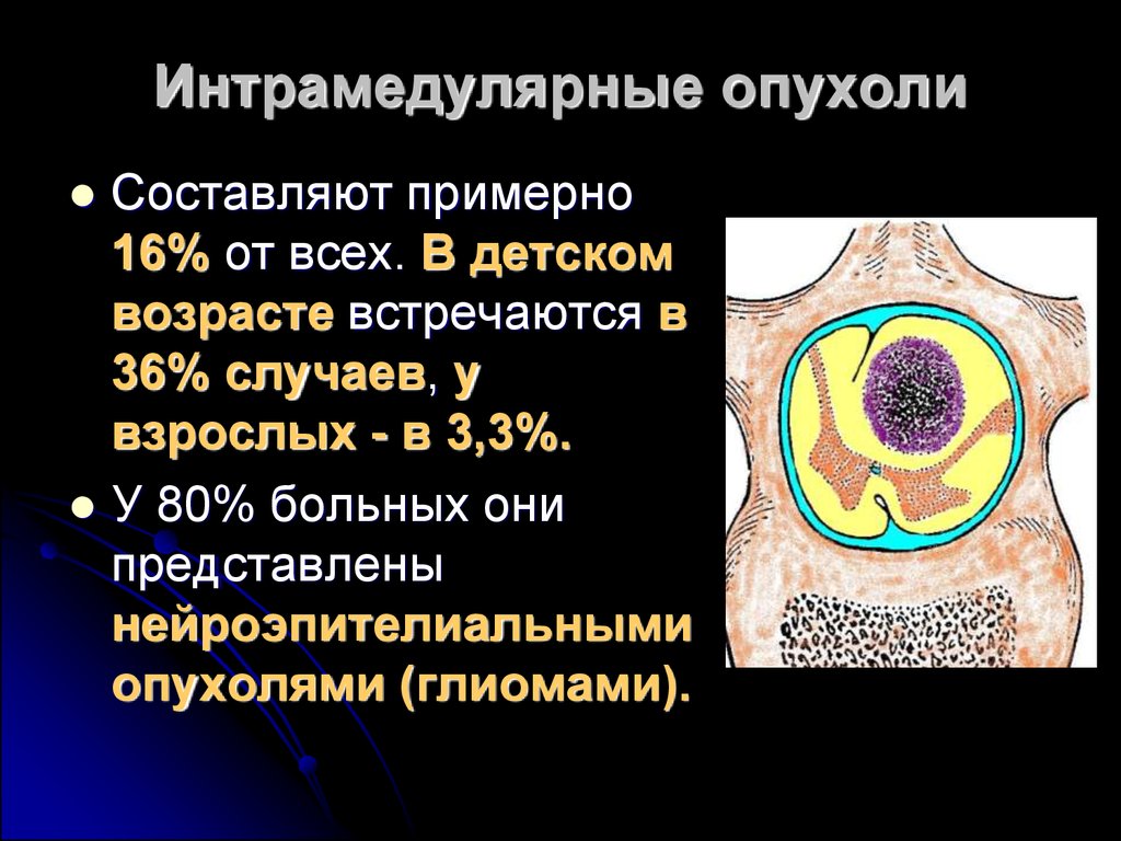 Опухоли спинного мозга презентация