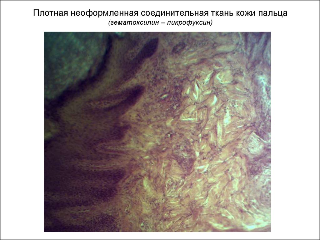 Ткани пальца. Плотная неоформленная соединительная ткань кожи пальца препарат. Плотная соединительная ткань кожи пальца препарат гистология. Плотная неоформленная соединительная ткань жировая ткань. Пикрофуксин соединительная ткань.