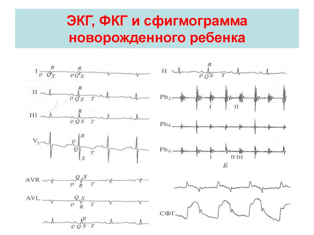 Экг детям. ЭКГ У новорожденных норма. Особенности ЭКГ У грудных детей. Изобразить синхронно записанные графики ЭКГ ФКГ СГ. Расшифровка ЭКГ У новорожденных таблица.