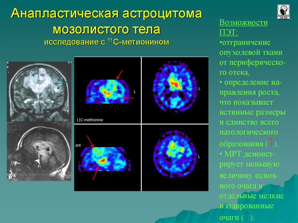 Пэт кт головного мозга. Диффузная астроцитома ПЭТ кт. Астроцитома на ПЭТ кт. Анапластическая астроцитома ПЭТ-кт.