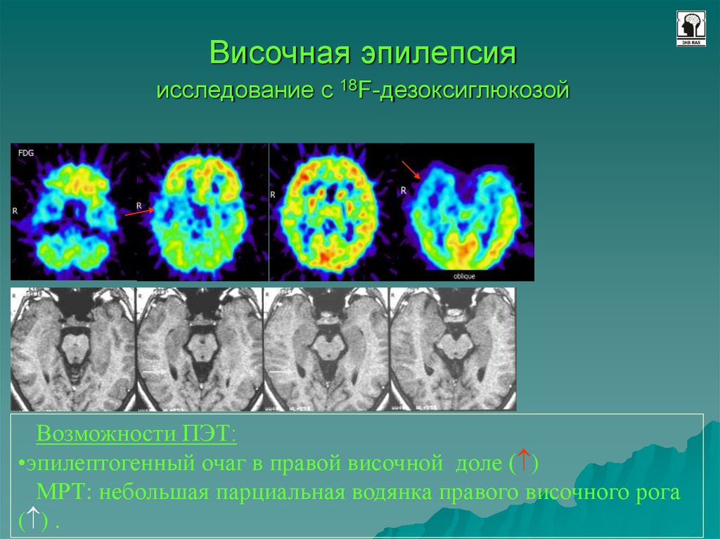Исследование эпилепсии. ПЭТ кт эпилепсия. ПЭТ кт при эпилепсии. Позитронно-эмиссионная томография. ПЭТ-кт головного мозга при эпилепсии.