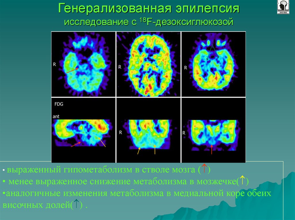 Исследование эпилепсии. ПЭТ кт эпилепсия. Позитронно-эмиссионная томография опухоли. ПЭТ-кт головного мозга при эпилепсии. Позитронно-эмиссионная томография мозга.