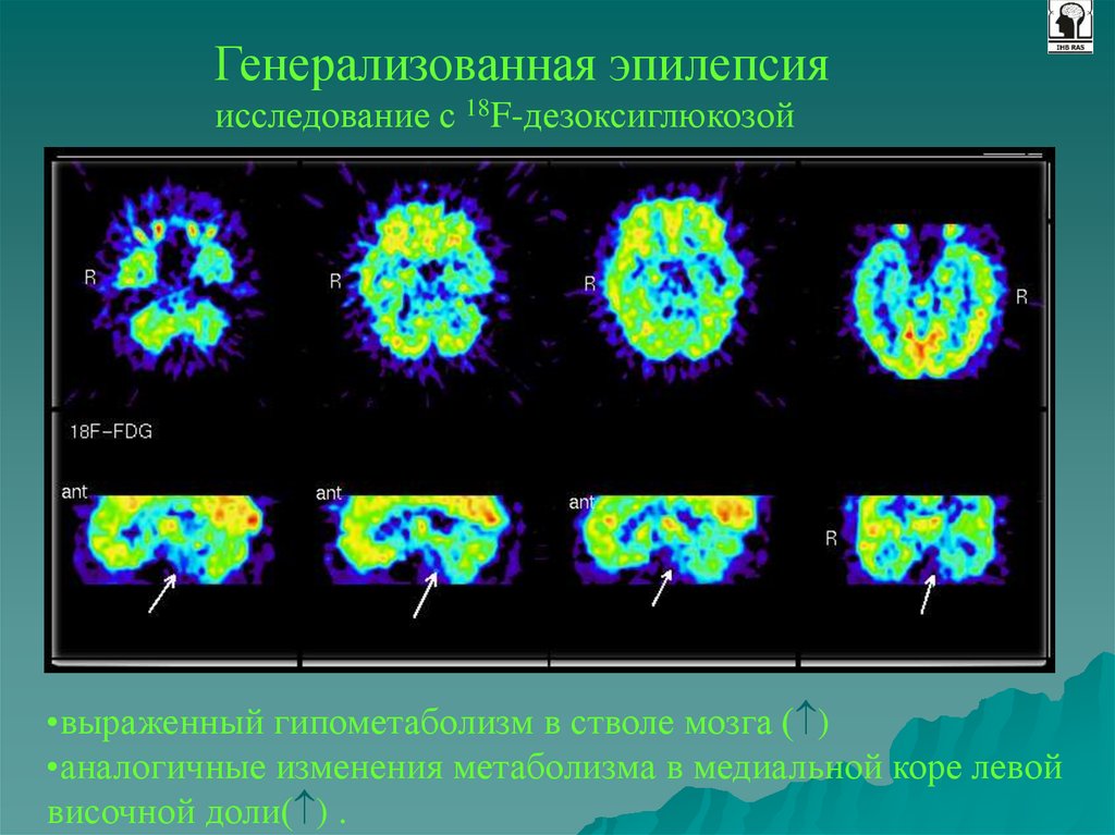 Исследование эпилепсии. ПЭТ эпилепсия. Позитронно-эмиссионная томография. ПЭТ кт эпилепсия. ПЭТ-кт головного мозга при эпилепсии.
