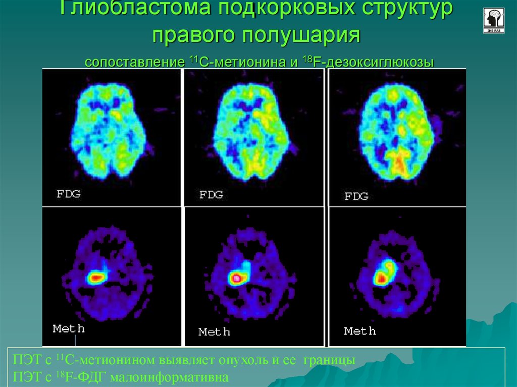 Рфп при пэт кт. Позитронно-эмиссионная томография мозга. Позитронно-эмиссионная томография опухоли. ПЭТ-кт головного мозга с 18 ФДГ.