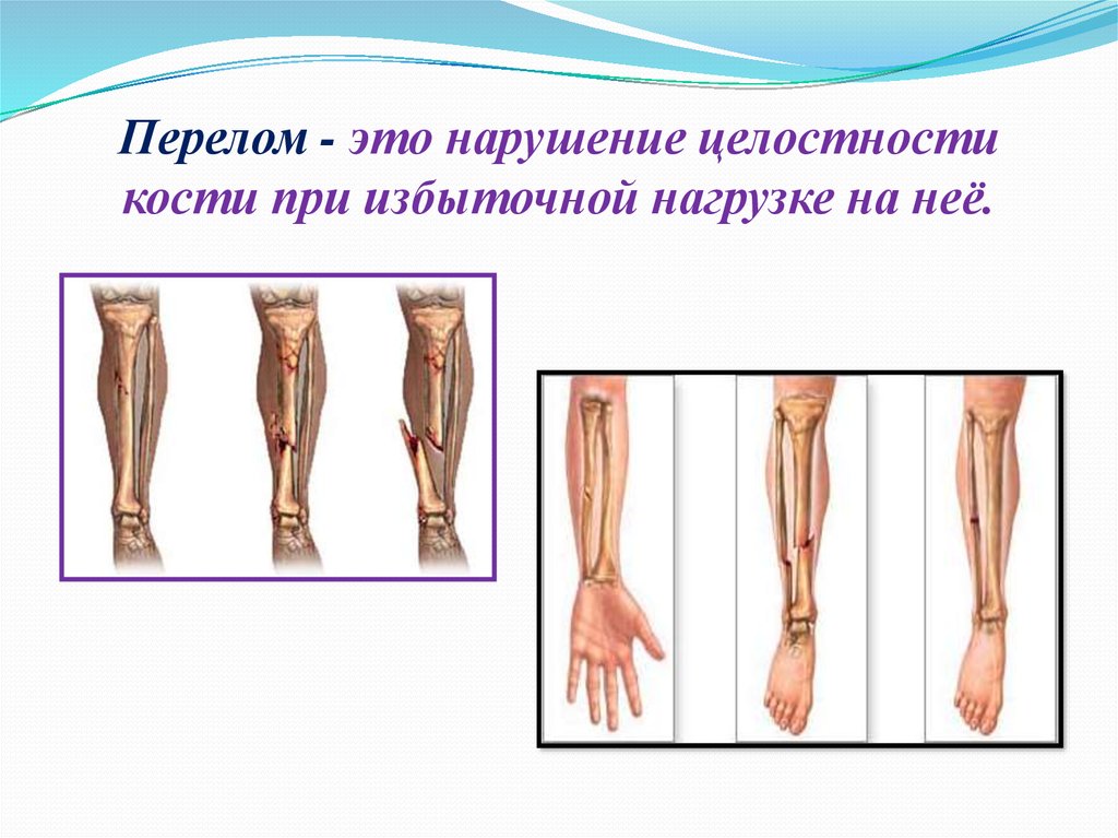 Нарушение целостности. Нарушение целостности кости. Комбинированный перелом.