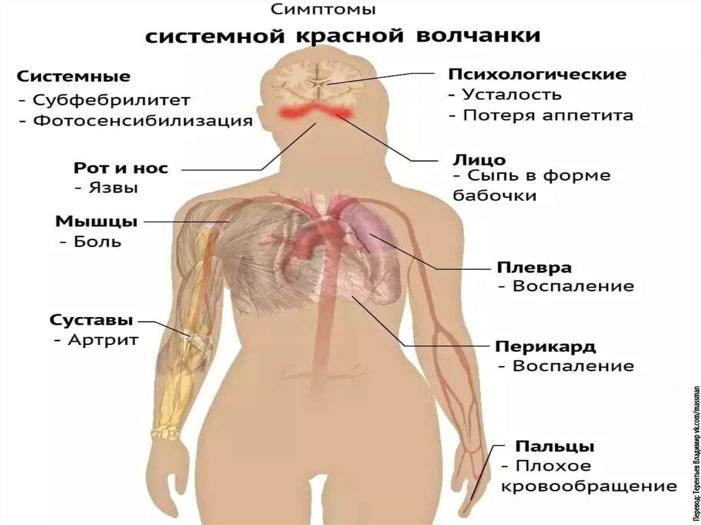 Системная красная. Системная красная красная волчанка. Системная красная волчанка клинические проявления. Системная красная красная волчанка симптомы. Красная волчанка .волчаночный нефрит.