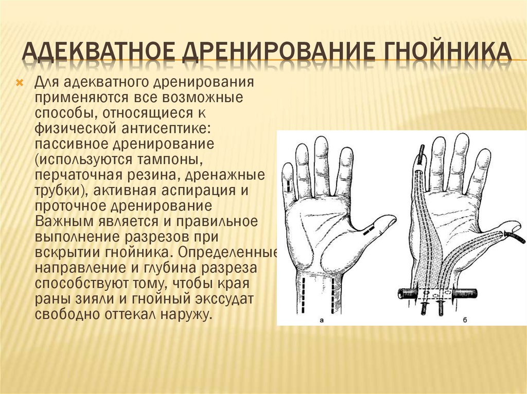 Картинки дренирование раны