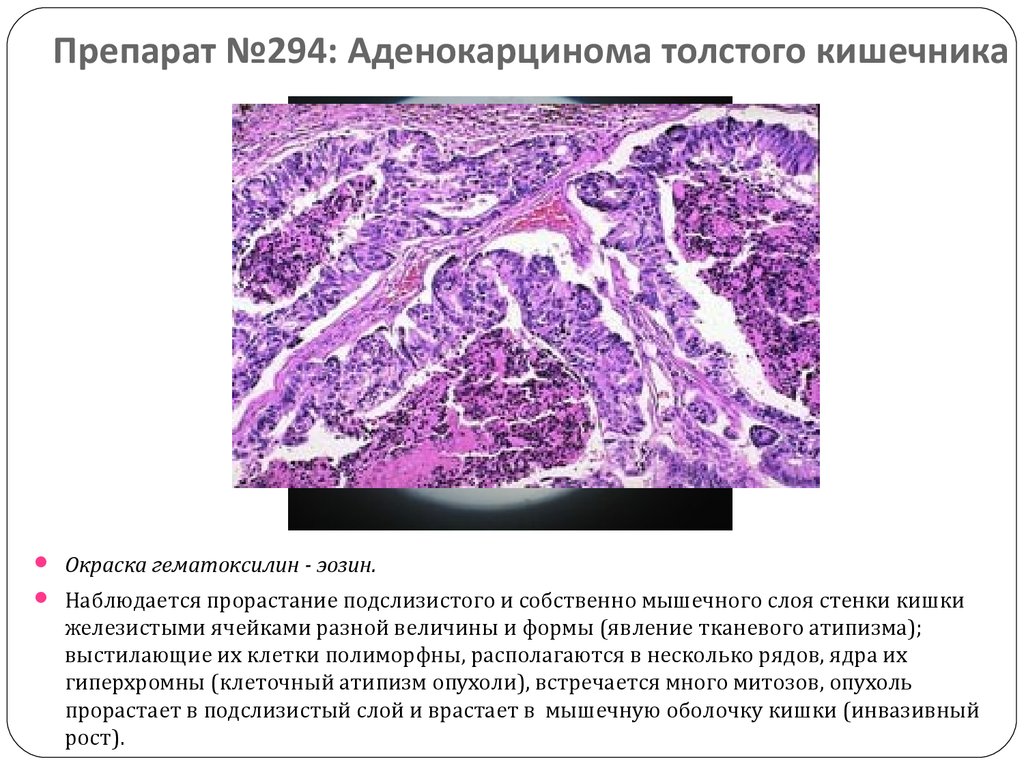 Аденокарцинома толстого кишечника