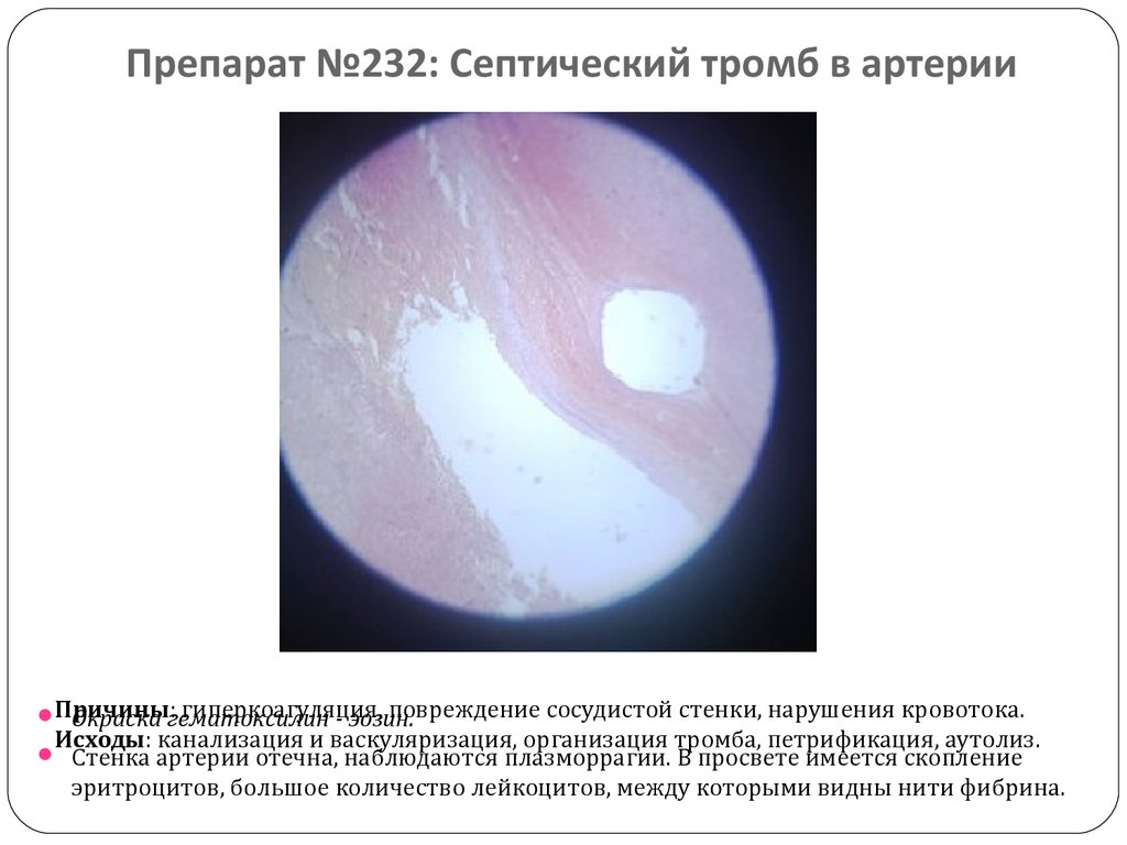 Препарат №232: Септический тромб в артерии