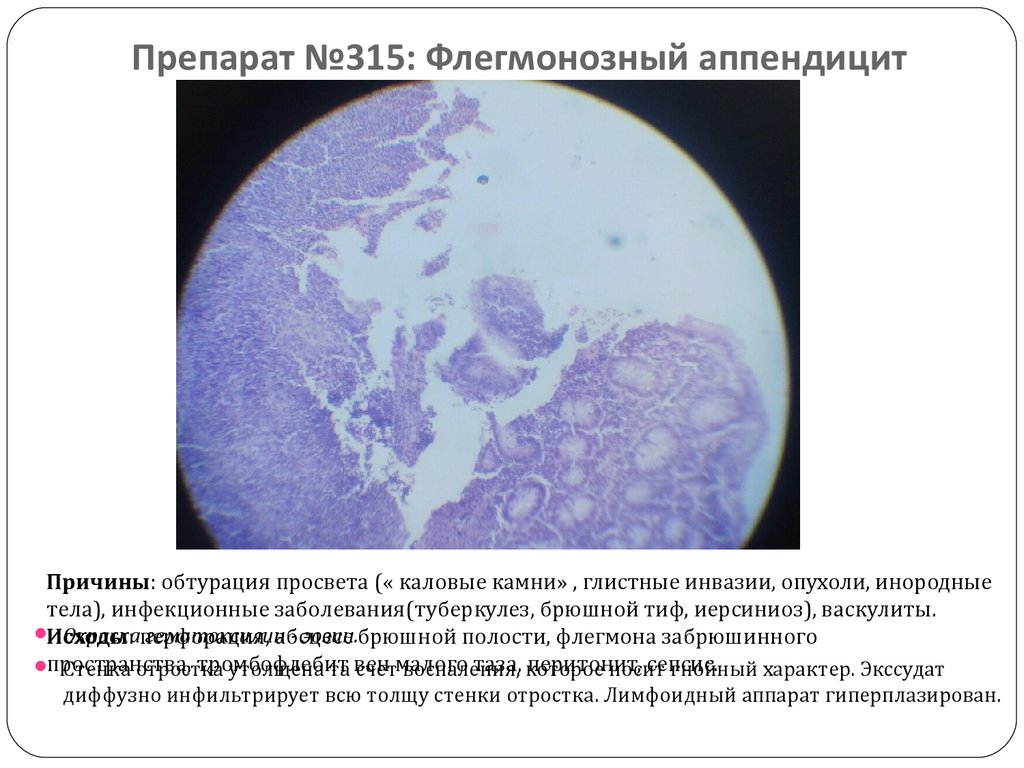 Препарат №315: Флегмонозный аппендицит