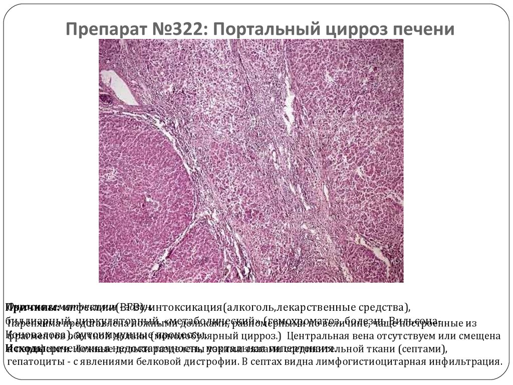 Портальный цирроз печени лечение