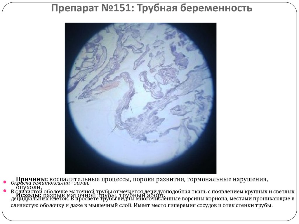 Трубная беременность микропрепарат. Трубная беременность патологическая анатомия микропрепараты. Трубная беременность гистология. Трубная беременность макропрепарат. Внематочная беременность патологическая анатомия.