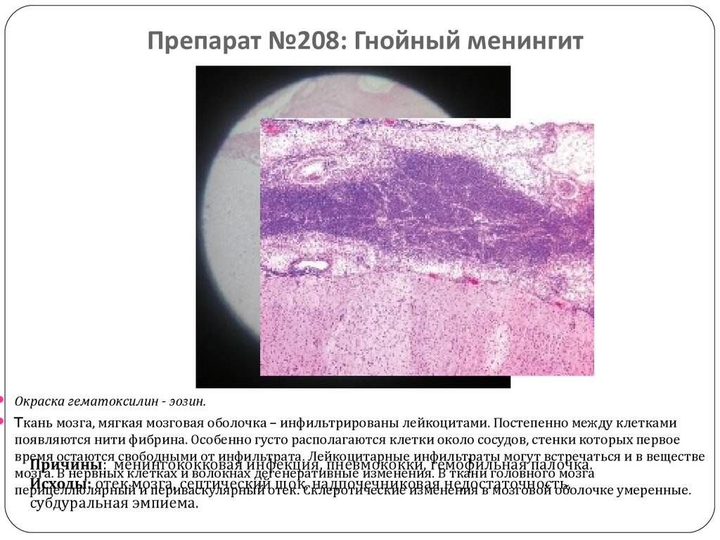 Туберкулезный менингит микропрепарат рисунок