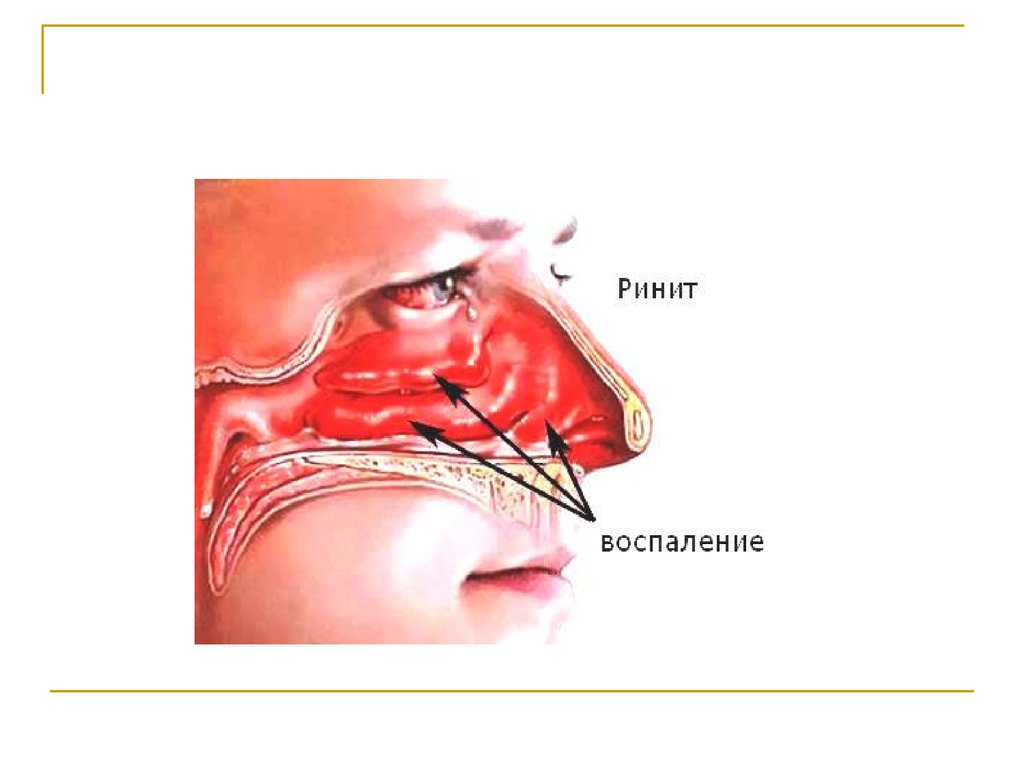 Сухие сопли в носу. Острый катаральный ринит. Хронический катаральный ринит симптомы. Аллергический ринит вазомоторный ринит.