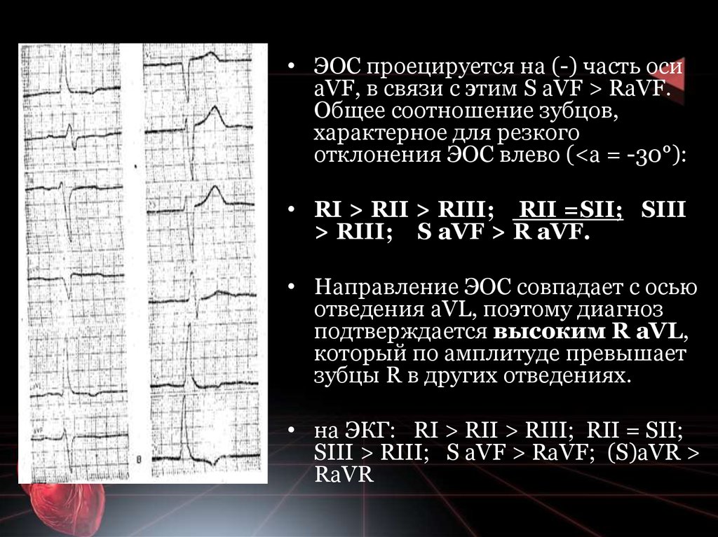 Экг ось отклонена влево. Электрическая ось сердца типа s1-s2-s3 на ЭКГ. Электрическая ось сердца s1-s2-s3. Отклонение ЭОС на ЭКГ. Электрическая ось вправо на ЭКГ.