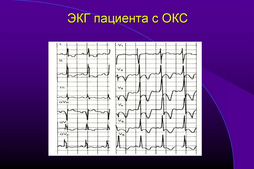 Окс с подъемом