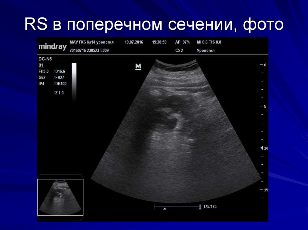 RS в поперечном сечении, фото