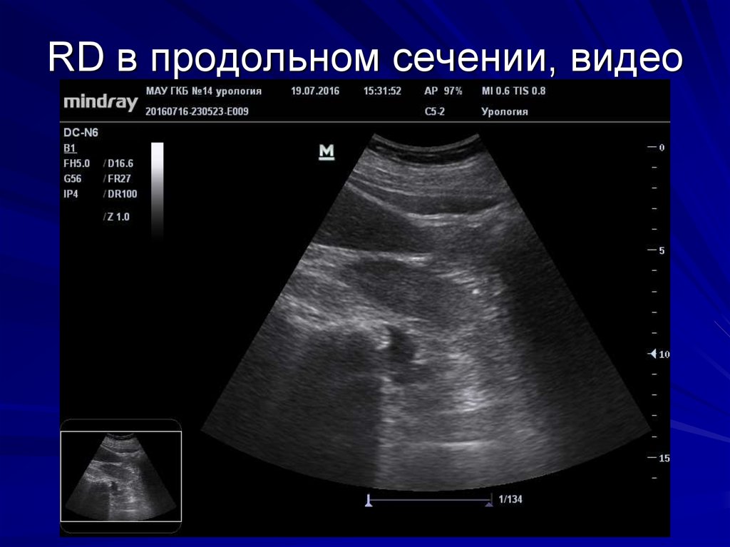 RD в продольном сечении, видео