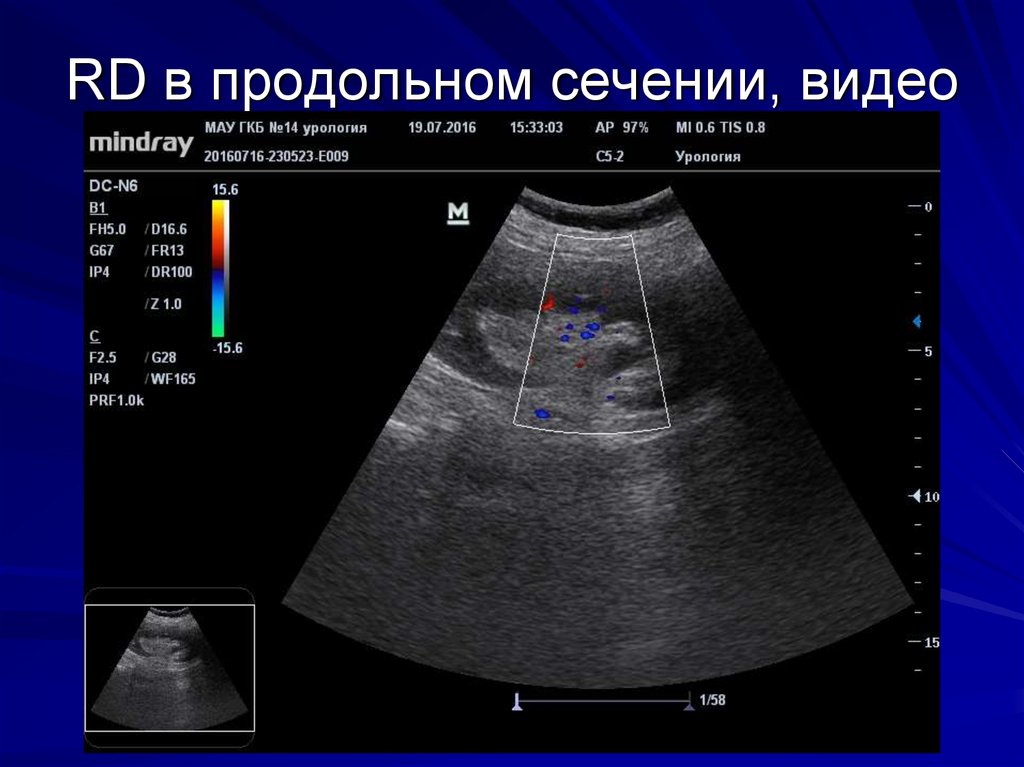 RD в продольном сечении, видео